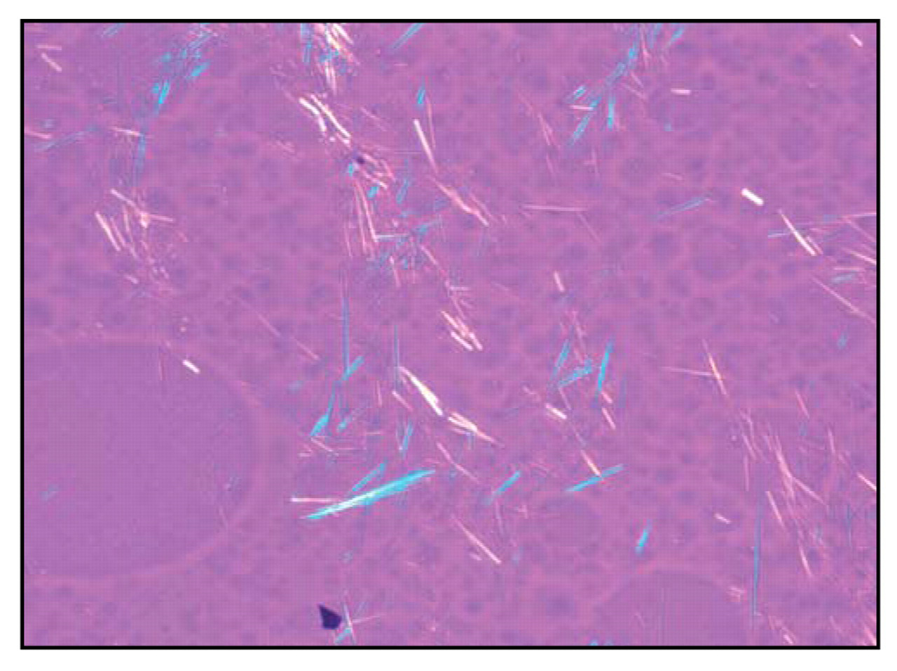 Tophaceous Gout in a Patient With Rheumatoid Arthritis, image size:1280x958