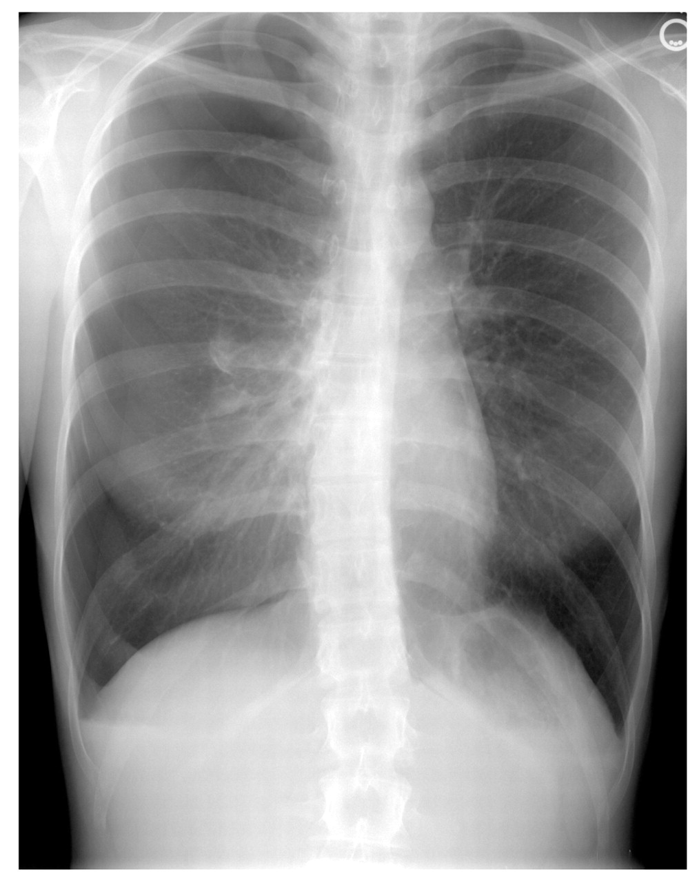 Figure 1.
Diagnostic chest radiograph of a 20-year-old woman who received a “bear hug” manual home remedy and was seen by physicians at Carl R. Darnall Army Medical Center (Fort Hood, Tex). This radiographic image reveals a pneumothorax greater than 50% on the right side with no bony fractures or evidence of tension pneumothorax.