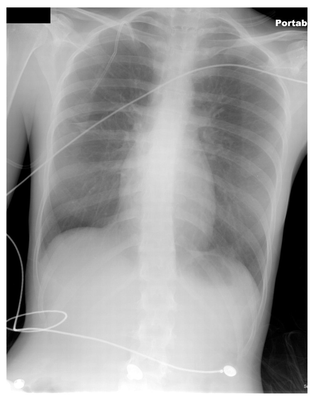 Figure 2.
Postprocedure chest radiograph of a 20-year-old woman who required a chest tube thoracostomy and hospitalization as a result of a pneumothorax. This radiographic image demonstrates the complete reexpansion of the patient's right lung with the catheter appropriately positioned.