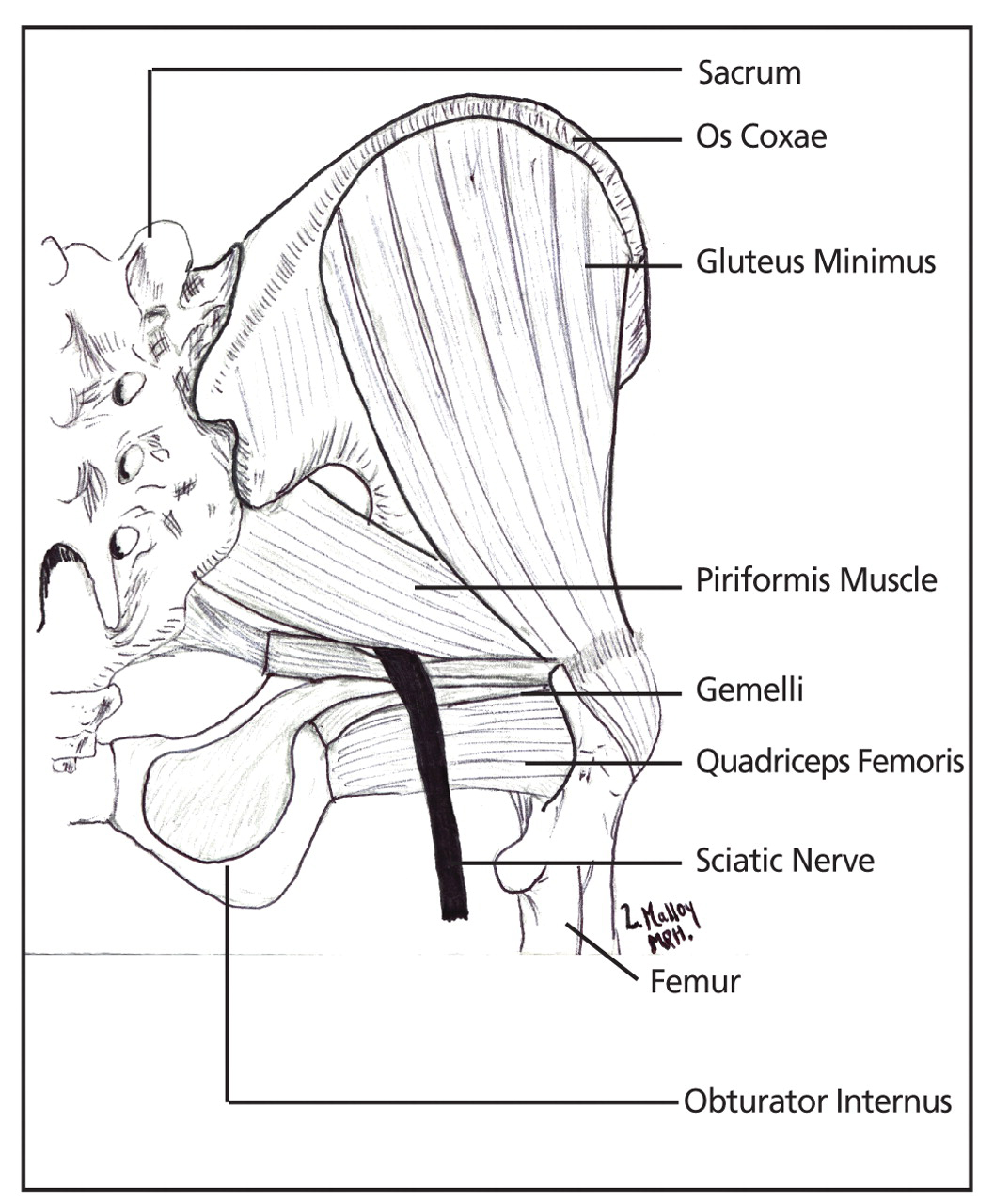Figure 1.
Anatomic features of the hip, including the most common orientation of the sciatic nerve, running inferior to the piriformis muscle.