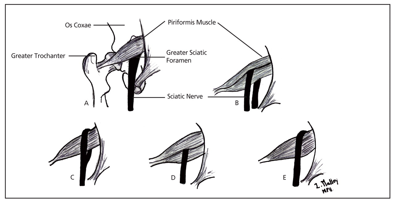 Figure 2.
Variations in the relationship of the sciatic nerve to the piriformis muscle: (A) the sciatic nerve exiting the greater sciatic foramen along the inferior surface of the piriformis muscle; the sciatic nerve splitting as it passes through the piriformis muscle with the tibial branch passing (B) inferiorly or (C) superiorly; (D) the entire sciatic nerve passing through the muscle belly; (E) the sciatic nerve exiting the greater sciatic foramen along the superior surface of the piriformis muscle.