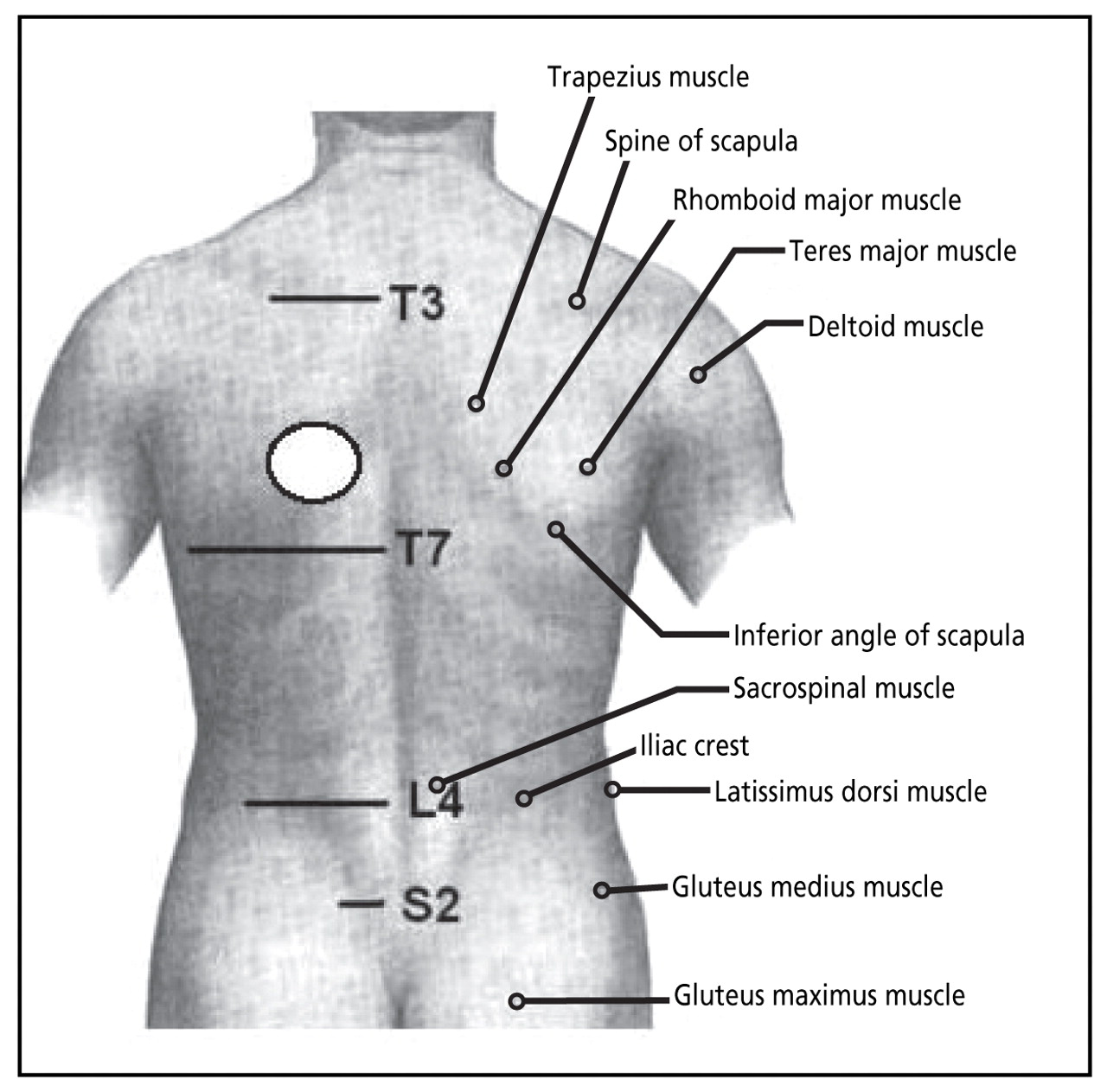   Figure. 
            
              Most common location of skin manifestations in patients with notalgia paresthetica is at the medial border of the left scapula. Adapted from Grey's Anatomy of the Human Body, 1918. Public domain. Abbreviations: T3, T7, L4, and S2 represent vertebrae in the thoracic, lumbar, and sacrum regions, respectively.
          