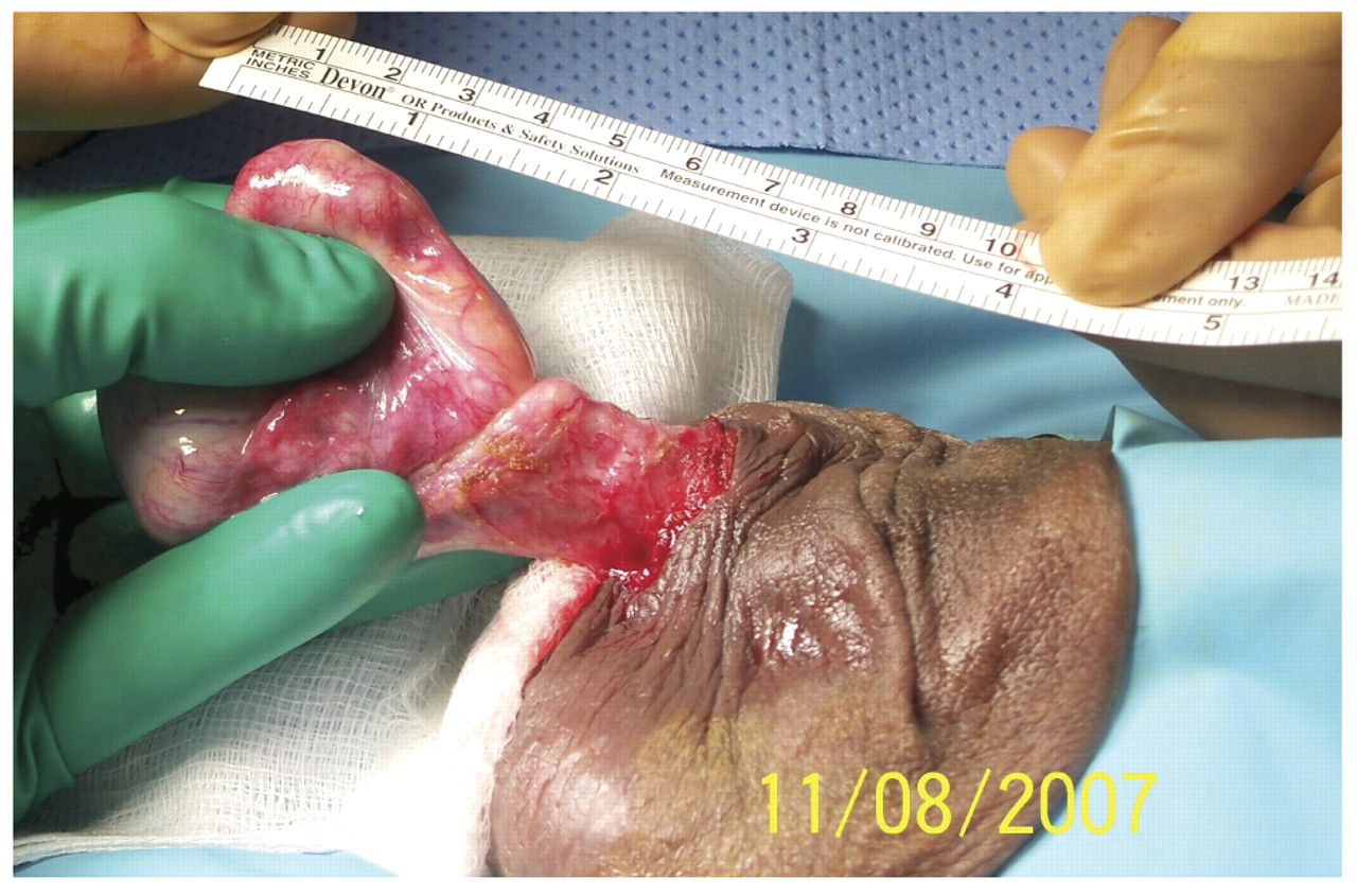 Figure 1.
Median-raphe scrotal incision used to excise an epididymal mass in a 39-year-old African American man. The mass was 2.3 × 1.6 × 1.1 cm, oval shaped, and firm.