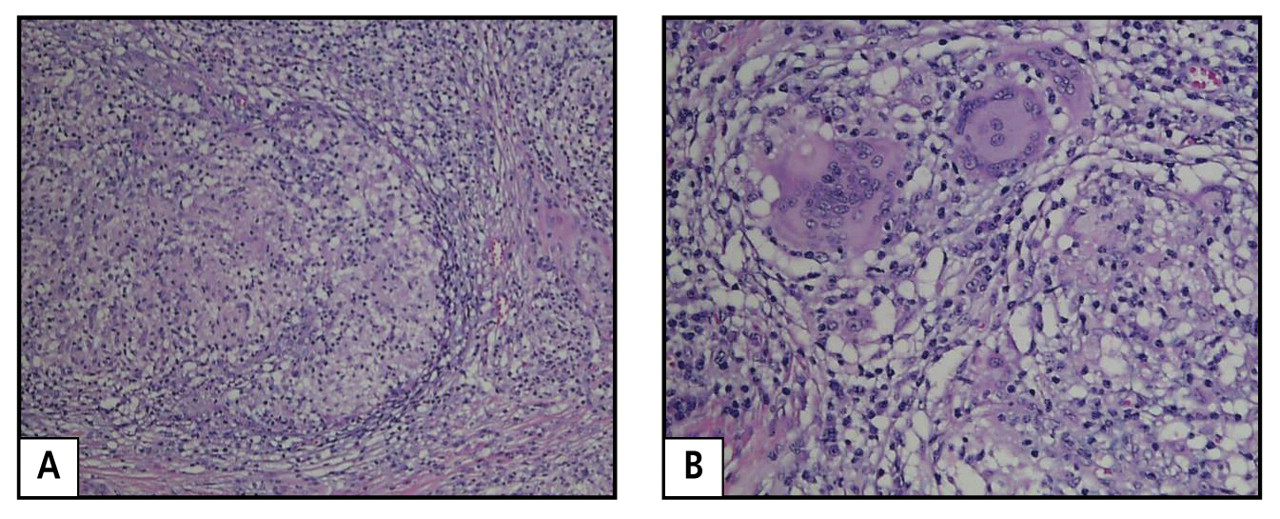 Figure 2.
Pathologic evaluation of the epididymal mass from a 39-year-old African American man revealed noncaseating granuloma (A; hematoxylin and eosin stain ×10). Higher power view (B; hematoxylin and eosin stain ×40) exposed multinucleated giant cells seen within a noncaseating granuloma. These findings, in addition to those from a computed tomography scan of the chest and lung biopsy, confirmed a diagnosis of sarcoidosis.