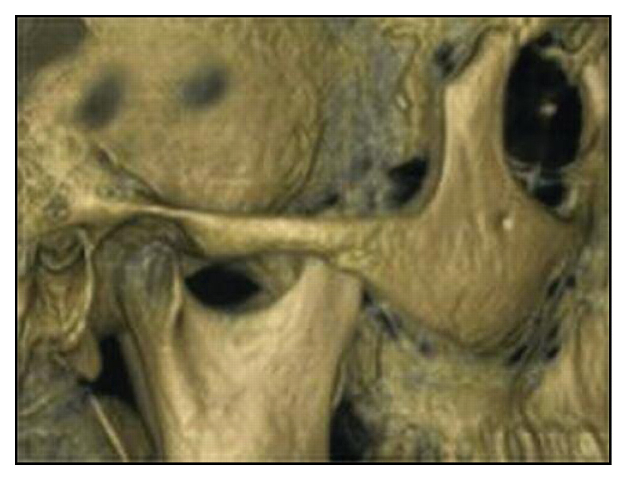 Figure 1.
Computerized 3-dimensional reconstruction with direct volume rendering from a sagittal magnetic resonance image of the right-sided temporomandibular joint region of a 28-year-old man.