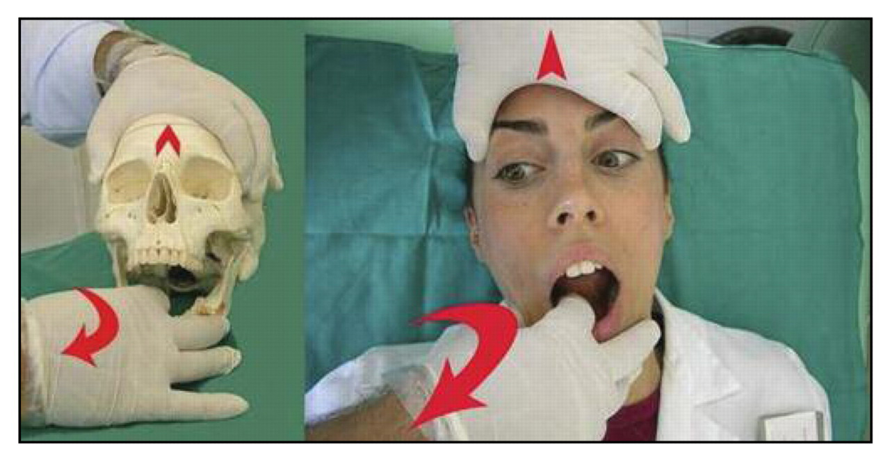 Supplemental Figure 1.
Technique for the release of the sphenomandibular ligament.