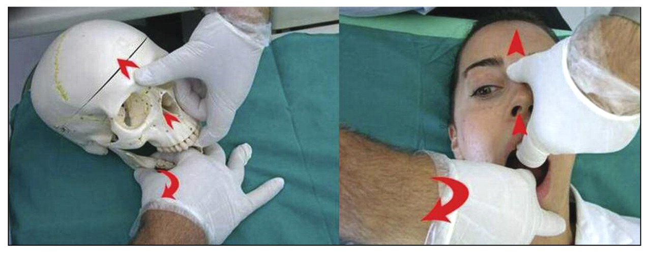 Supplemental Figure 2.
Technique for the release of the sphenomandibular ligament.