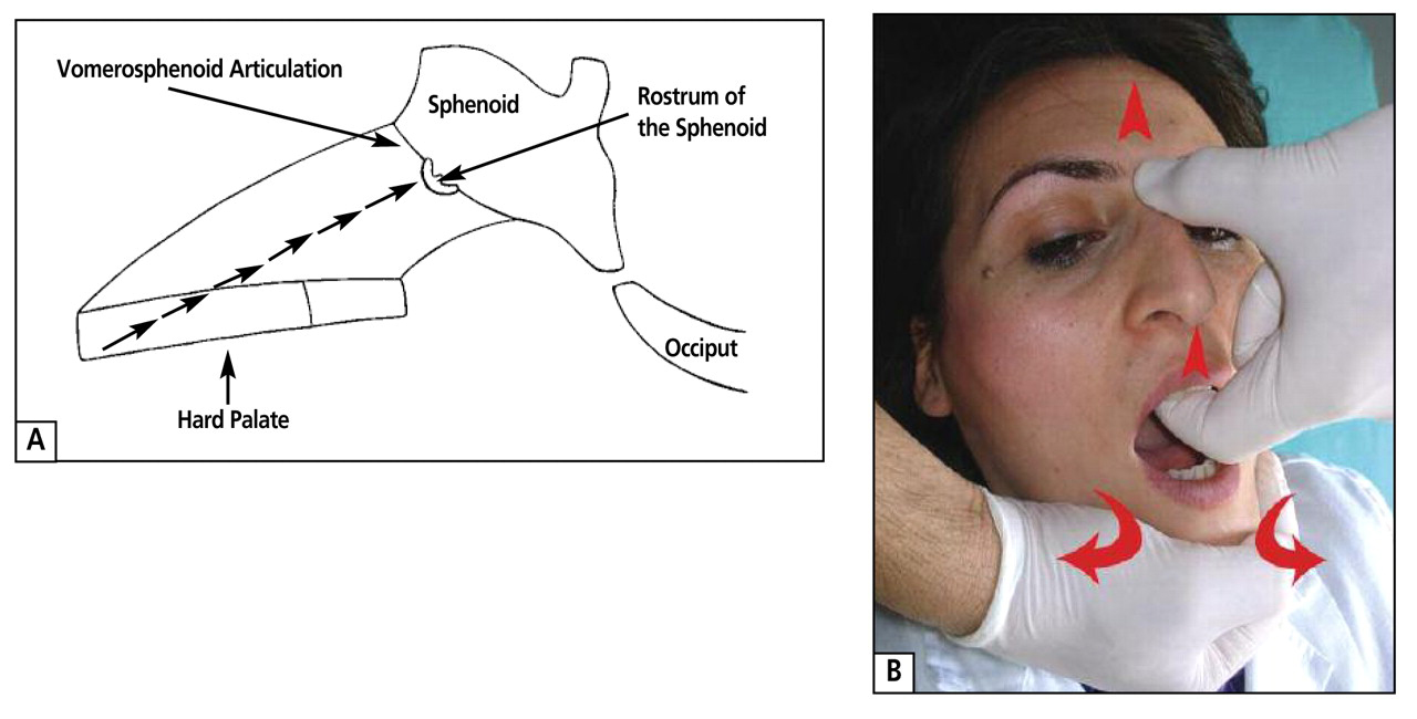 Supplemental Figure 3.
(A) Image depicting pressure points for release of the sphenomandibular ligament. Pressure is applied to the hard palate, causing compression of the vomer into the rostrum of the sphenoid. Adapted from Upledger JE, Vredevoogd JD. Craniosacral Therapy. Seattle, WA: Eastland Press; 1983. (B) Image depicting technique for the release of the sphenomandibular ligament.