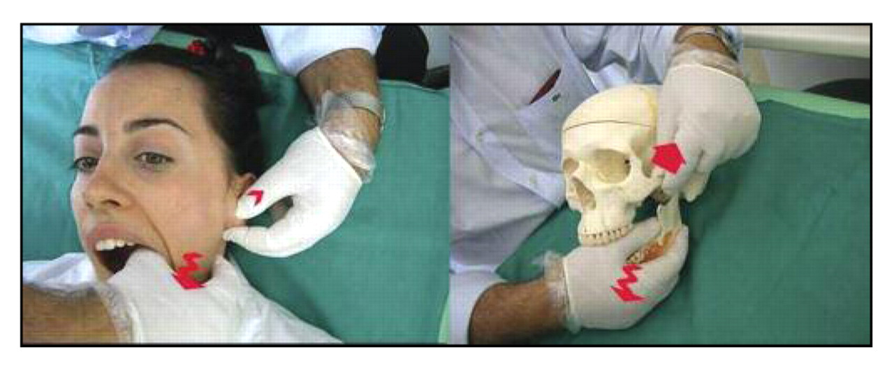Supplemental Figure 4.
Technique for the release of the stylomandibular ligament.