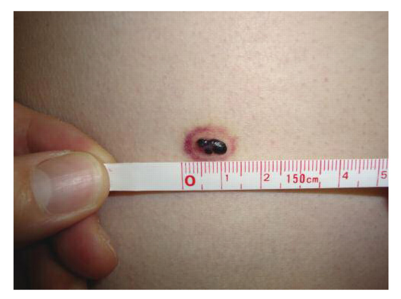 Figure.
A 6-mm violaceous papule with a surrounding 1.5-cm annular, nonblanching, erythematous halo in a 26-year-old man.