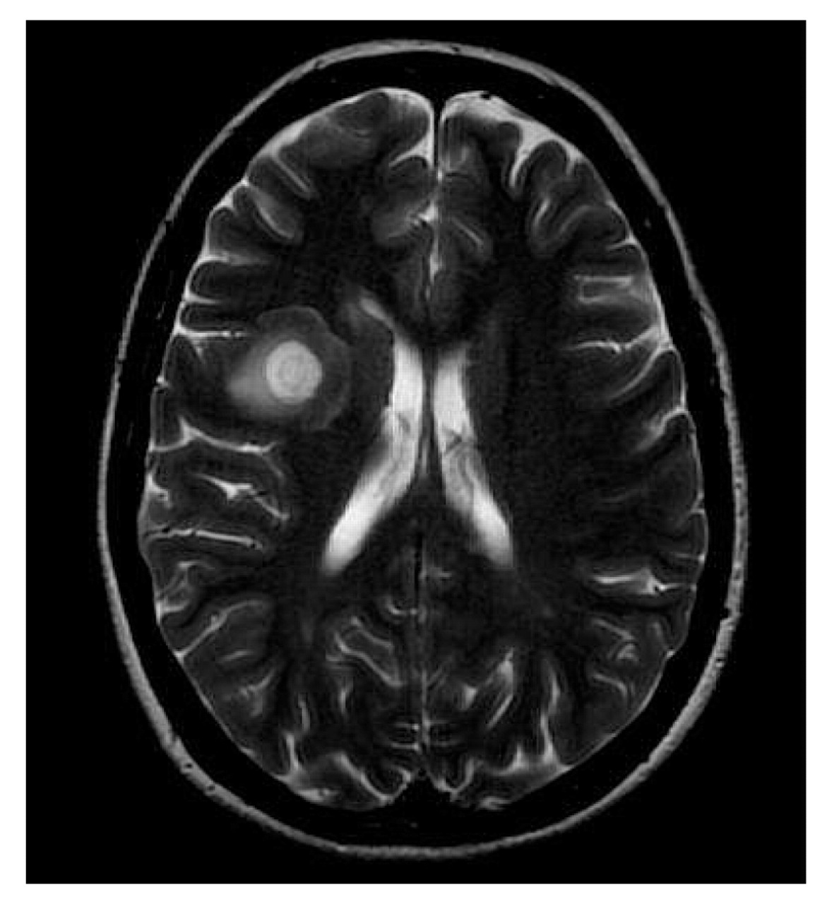 Figure 1.   
            
              Pathognomonic brain magnetic resonance imaging findings in a 30-year-old woman with Balò disease. T2-weighted axial image obtained at admission shows alternating concentric zones of demyelinated and myelinated white matter in the right frontal region, consistent with a diagnosis of Balò disease.
            
          