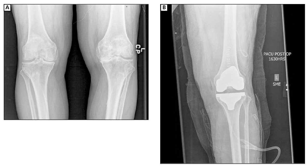 Figure 3.
Preoperative (A) and postoperative (B) radiographs of a patient with symptomatic left knee arthritis who underwent left total knee arthroplasty. Standard components include a cemented femoral component and a cemented tibial component (both made from cobalt chrome) with a polyethylene insert. Of note, the mechanical alignment of the knee was restored.