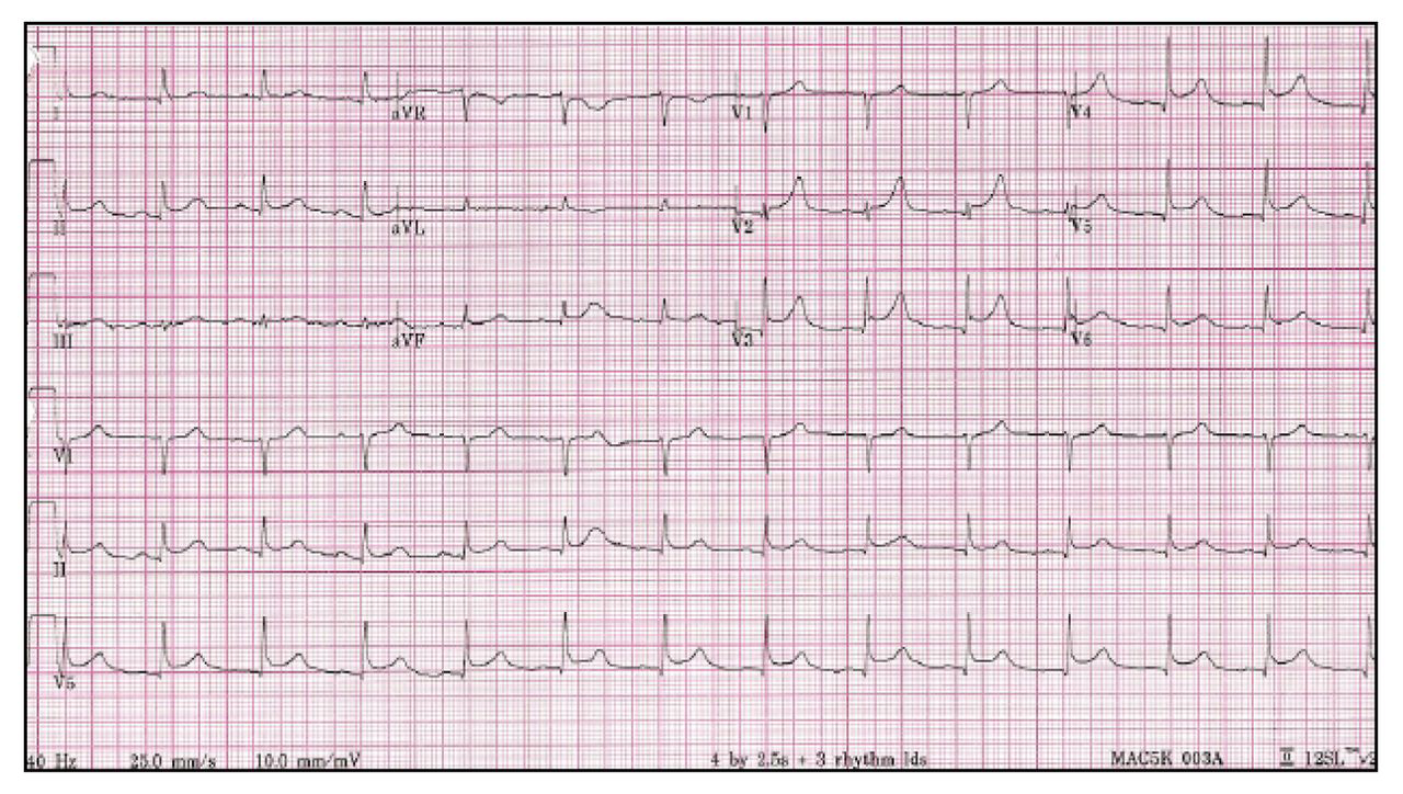 Figure 1.
Electrocardiogram obtained on the night after hospital admission of a 68-year-old man shows ST-segment elevation in the inferior and anterolateral leads. This image also demonstrates ST-segment depression in lead aVR and absence of ST-segment elevation in lead V1—findings that are highly sensitive and specific for the diagnosis of stress-induced cardiomyopathy.