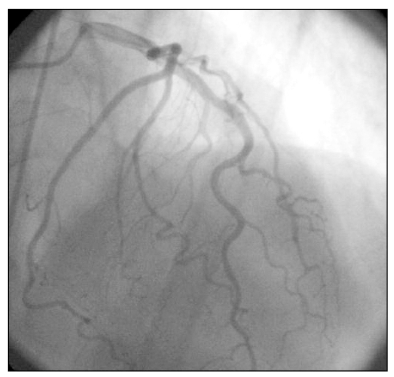 Figure 2.
Cardiac catheterization showing anatomy of the left coronary artery and its main branches. Minimal (<50%), nonobstructive coronary artery disease was noted.