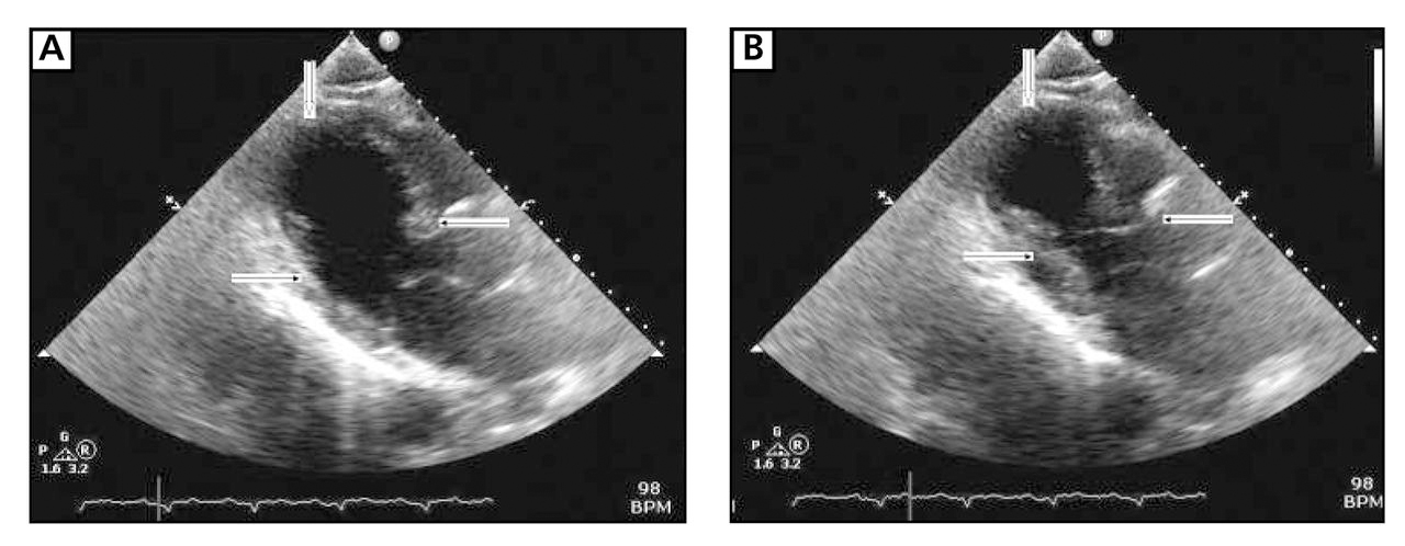 Figure 3.
Long-axis precordial end diastolic (A) and end systolic (B) views from transthoracic echocardiogram immediately after cardiac catheterization demonstrate basilar hyperactivity (line arrows), apical dyskinesia (block arrows), and distal inferior and anterior wall akinesia. The ejection fraction was estimated to be 30% to 40%.
