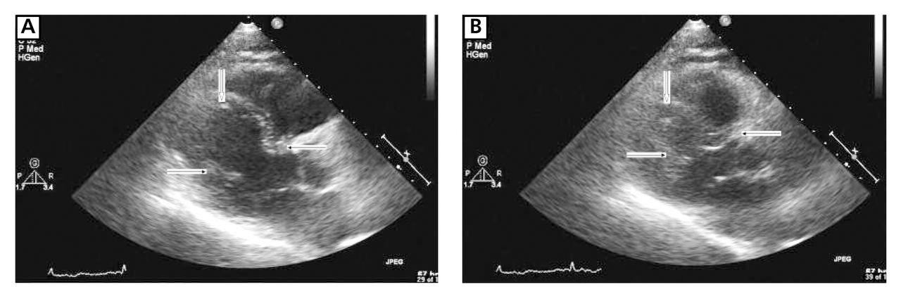 Figure 4.
Long-axis precordial end diastolic (A) and end systolic (B) views obtained on day 5 of hospital admission demonstrate near-complete resolution of apical dyskinesia and distal inferior and anterior wall akinesia. The ejection fraction was estimated at 60% to 65%.