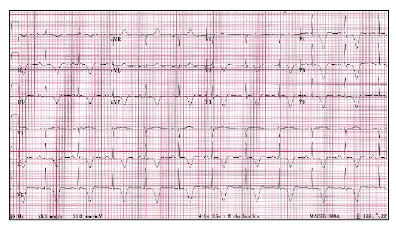 Figure 5.
Electrocardiogram obtained 19 days after patient's initial hospital admission date demonstrates resolution of ST-segment elevation in the inferior and anterolateral leads. Deep, diffuse T-wave inversions can now be seen in these leads.