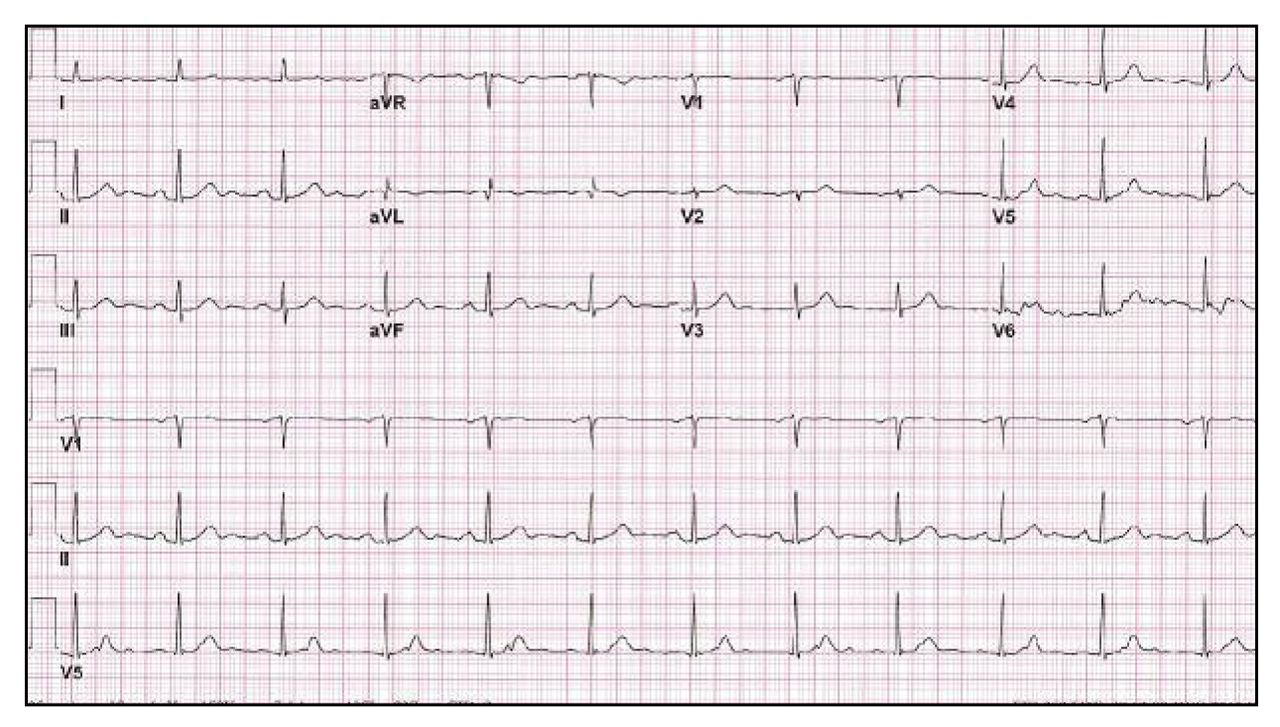 Figure 6.
Electrocardiogram obtained 3 months after the patient's admission demonstrates complete resolution of ST-segment and T-wave abnormalities.
