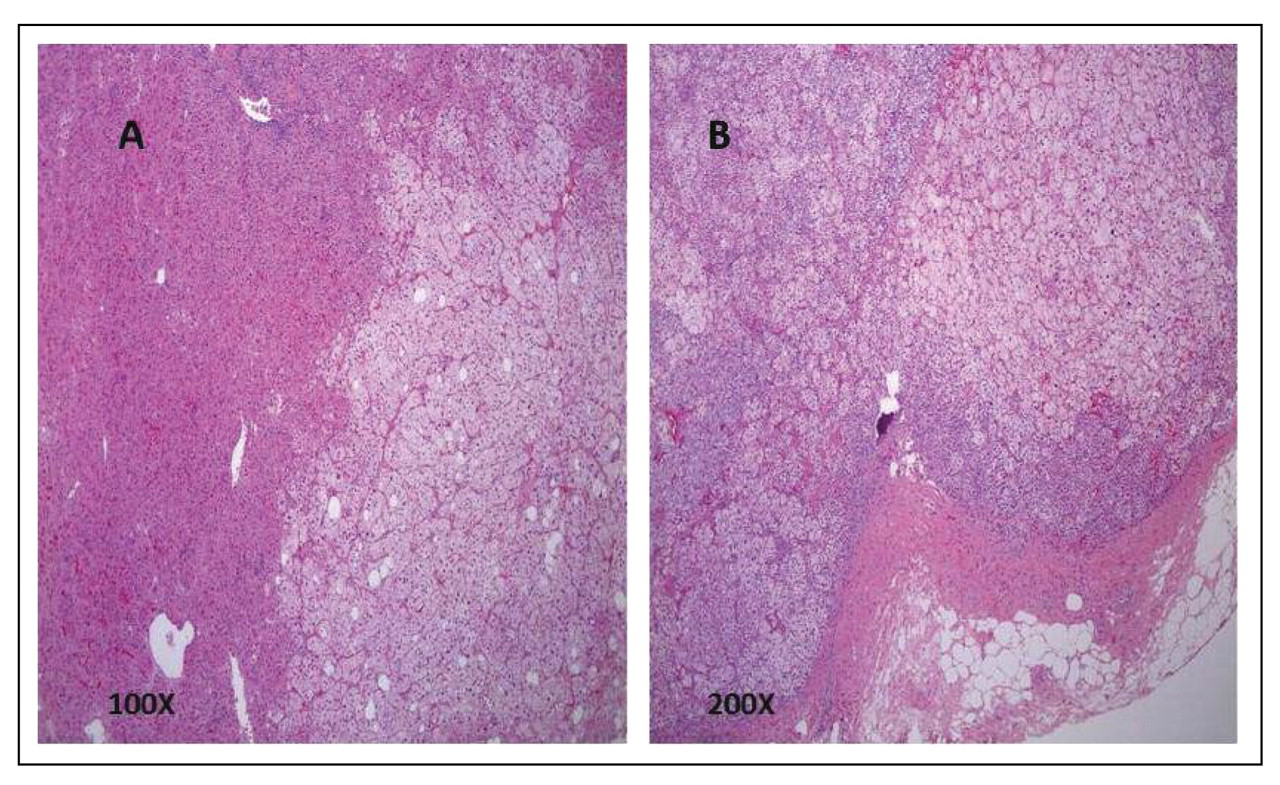 Figure 1. 
          
            Hematoxylin and eosin–stained resected adrenal tissue of the patient at low magnification (A, ×100) and high magnification (B, ×200), revealing macronodular cortical hyperplasia with a dominant hyperplastic nodule and no evidence of malignancy.
        