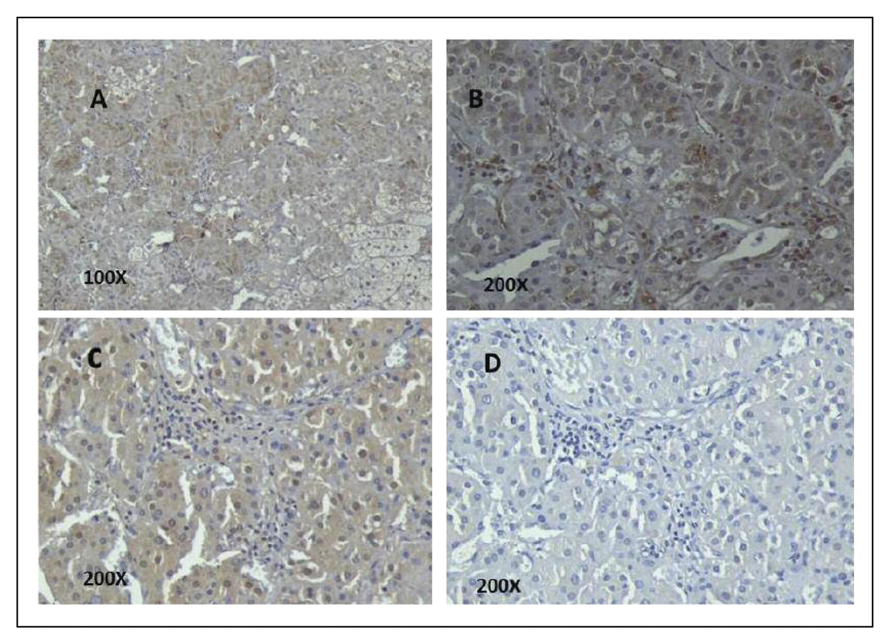Figure 3. 
          
            Immunostaining of the patient's adrenal tissue reveals high levels of Toll-like receptor 4 (TLR4) in the dominant nodule (A), as well as in the cytoplasm of adrenal epithelial cells that were being infiltrated by the inflammatory cells (B). Staining also showed TLR4 in some of the inflammatory cells and in endothelial cells of the capillaries and larger vessels within the adrenal gland (B). Positive TLR3 immunoreactivity results were seen in the adrenal epithelial cells but not in endothelial cells or inflammatory cells infiltrating the adrenal gland (C). Immunostaining for Wnt-5a (wingless-type MMTV integration site family, member 5A) showed negative results in the tumor tissue and adrenal epithelial cells (D).
          
        