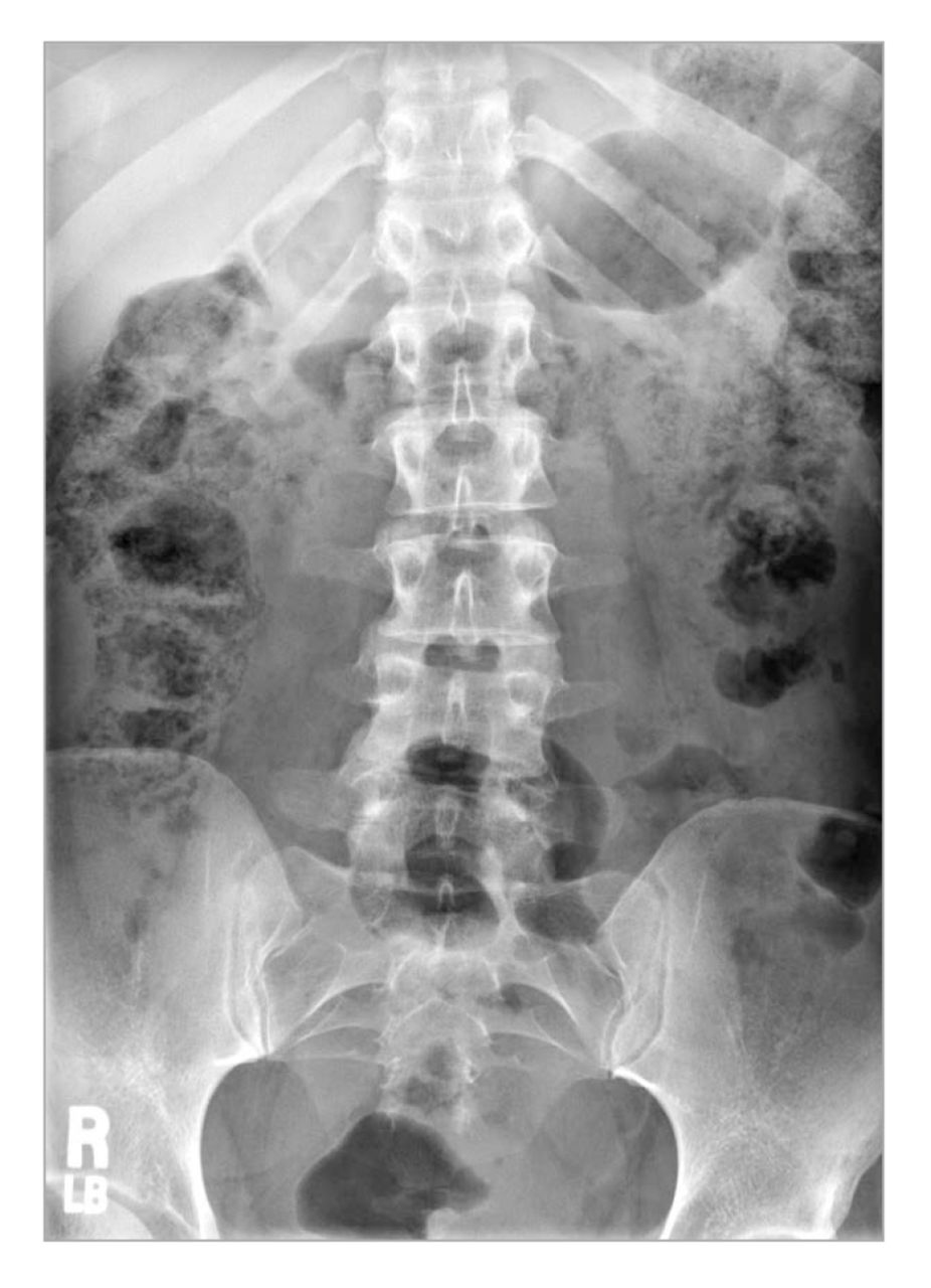 Figure 1. 
            Lumbosacral plain radiograph exhibiting mild left convex scoliosis.
          