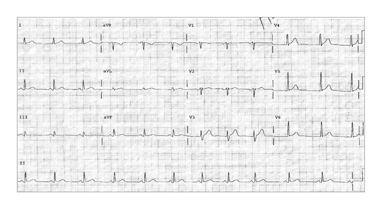 Figure. 
            An electrocardiogram of a 32-year-old man with left-sided chest pain revealed subtle upward sloping T waves in anterior precordial leads and subtle PR depression in the inferior leads.
          