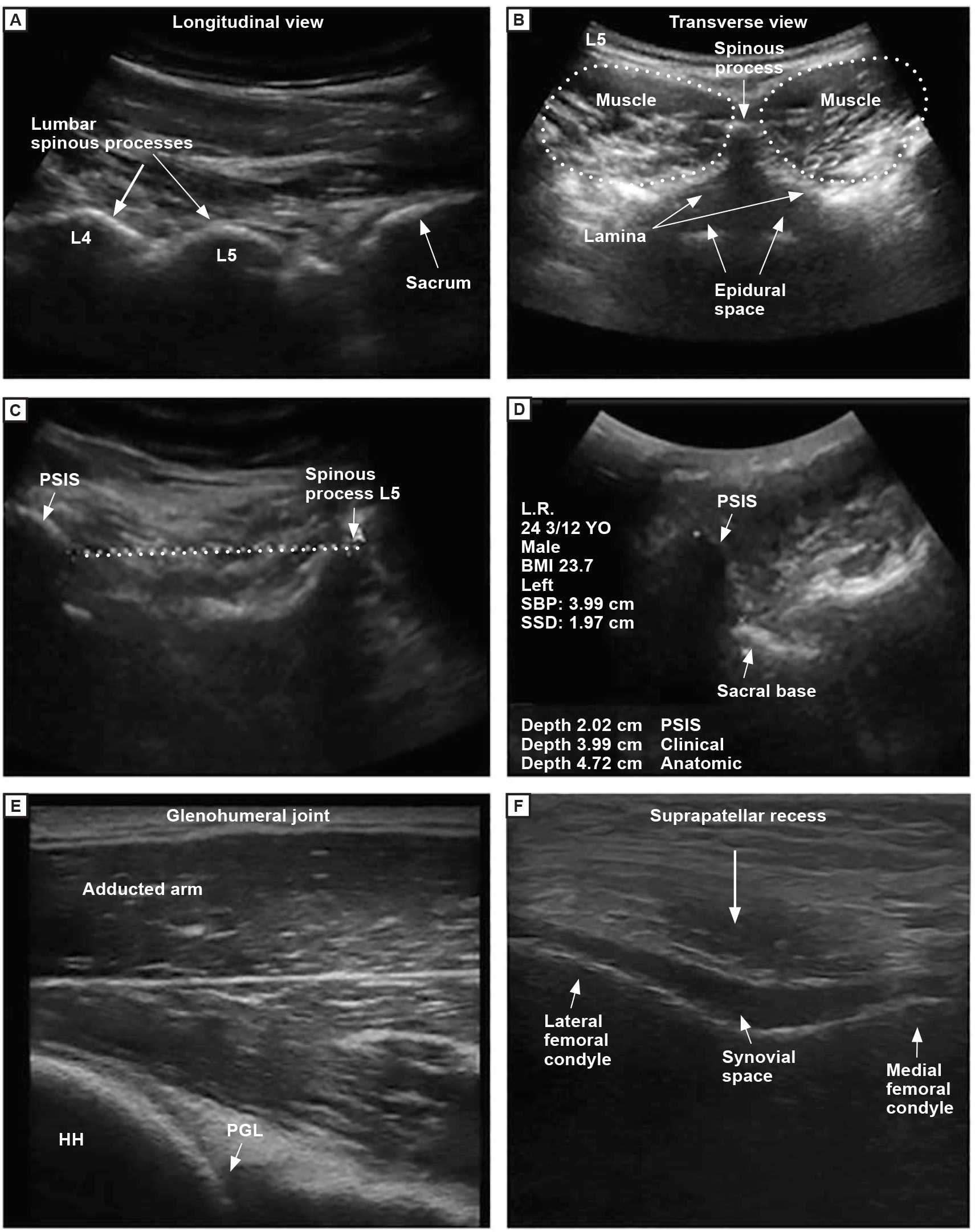 Figure. 
          Examples of ultrasonography images taken by first- and second-year osteopathic medical students. (A) Lumbar spine in the longitudinal view. (B) Lumbar spine in the transverse view. (C) Spinous process of the fifth lumbar vertebra (L5) and posterior superior iliac spine (PSIS) in the transverse view. (D) Sacral base position and sacral sulcus depth. (E) Posterior glenohumeral joint with the arm in the adducted position. (F) Suprapatellar recess in the transverse view (sunrise view). Abbreviations: HH, humeral head; PGL, posterior glenoid labrum.
        