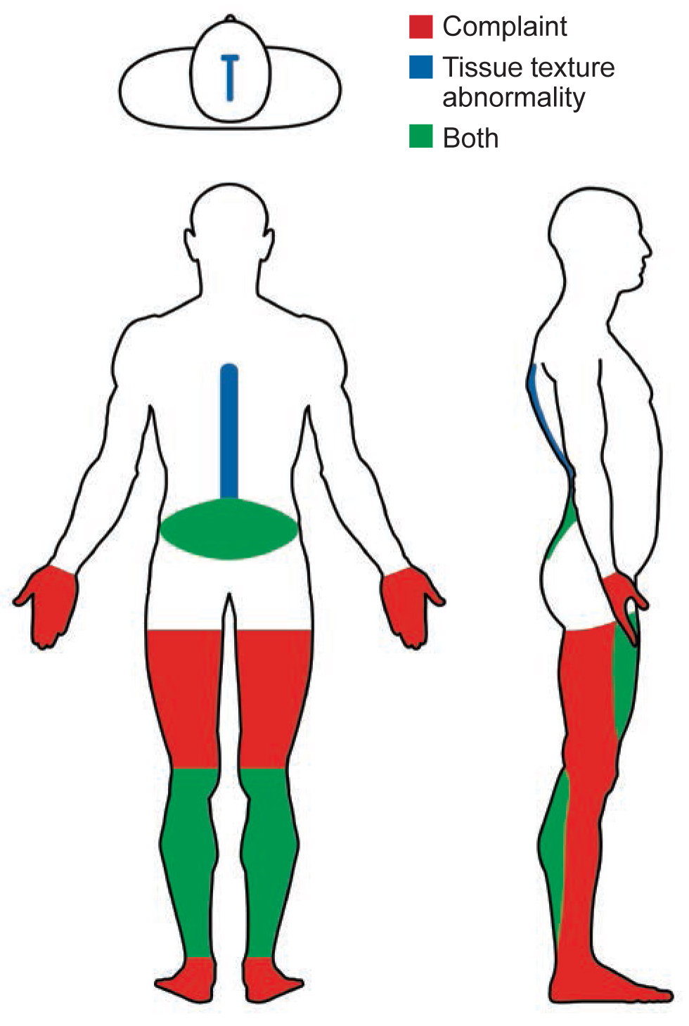 Figure.
Areas of the body of a 52-year-old man with stiff person syndrome shaded to refect pain reported by the patient and tissue texture abnormalities documented by his osteopathic physician.