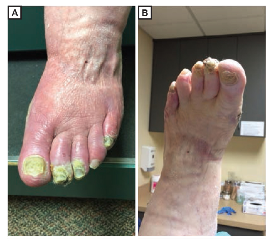 Figure 1.
Erythromelalgia, or dependent rubor, with the dorsal foot in the dependent position (A) or at 60° in the horizontal position for 2 minutes (B).