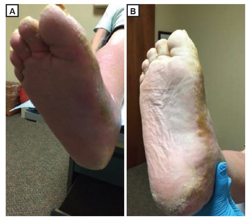 Figure 2.
Erythromelalgia, or dependent rubor, with the plantar foot in the dependent position (A) or at 60° in the horizontal position for 2 minutes (B).
