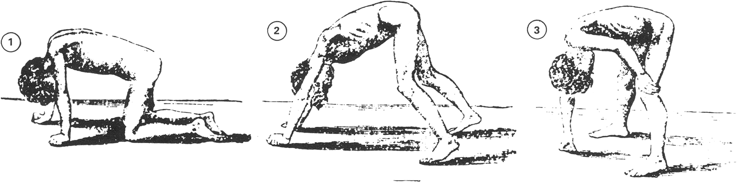 Figure 2. 
          Gowers sign: the inability to rise and lift the upper body without using the hands and arms to push and climb. To compensate for proximal lower limb muscles weakness, the DMD patient trying to rise from the floor (1) uses his arms and shoulder girdle, (2) forms a triangle, and (3) climbs on own thighs to stand up. Reprinted from Gowers WR. Clinical lecture on pseudohypertrophic muscular paralysis. Lancet. 1879;ii:73-75. Public Domain.
        