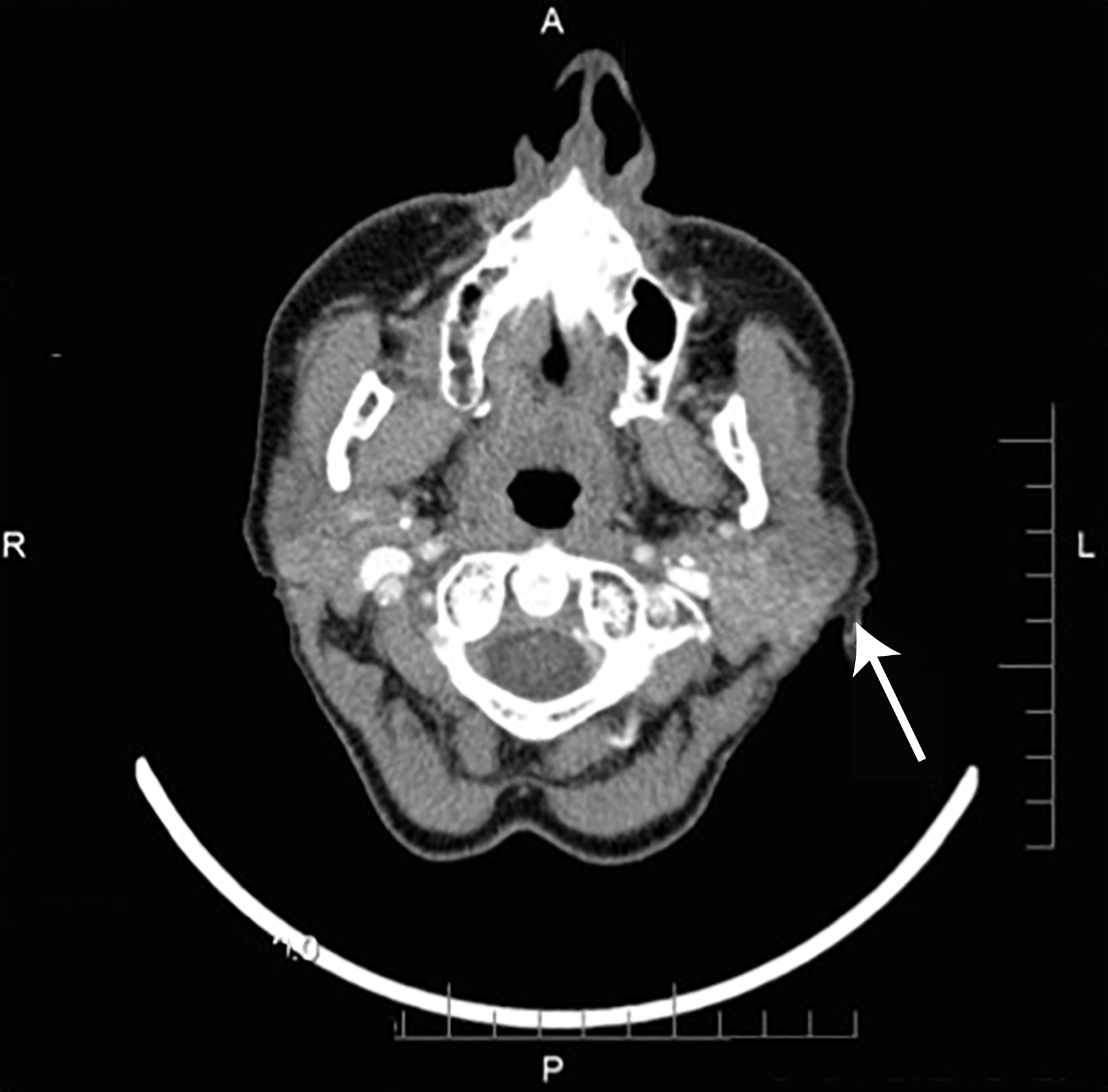 
          Figure.
         
          Computed tomographic image of a 50-year-old woman who presented with left-sided preauricular pain and swelling that radiated into her neck and jaw. The image demonstrates diffuse parenchymal enhancement in the left parotid gland and associated acute cervical lymphadenopathy. Arrow points to the left posterior parotid gland tail with thickening and enhancement.
        