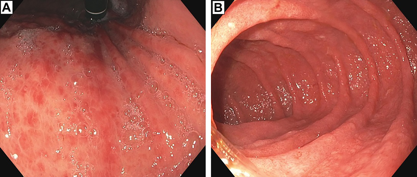 
          Figure 1.
         
          An image taken during esophagogastroduodenoscopy 2 weeks after ipilimumab administration revealed (A) severely inflamed, diffusely erythematous mucosa in the stomach and (B) diffusely erythematous, congested mucosa with overlying exudate in the duodenum.
        