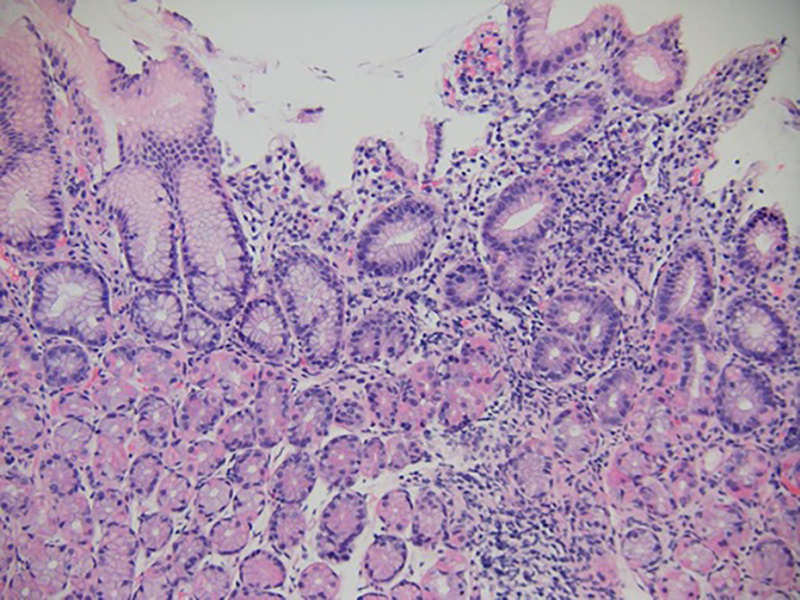 
          Figure 2.
         
          Gastric biopsy specimen taken 2 weeks after ipilimumab administration demonstrated focally active gastritis without granuloma formation (hematoxylin-eosin, original magnification ×100).
        