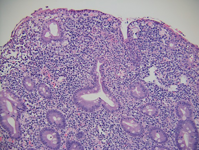 
          Figure 3.
         
          Duodenal biopsy specimens taken 2 weeks after ipilimumab administration demonstrated active duodenitis with acute cryptitis, crypt abscess formation, and mild villous blunting (hematoxylin-eosin, original magnification ×100).
        