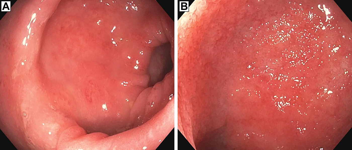 
          Figure 4.
         
          Colonoscopy with examination of the terminal ileum taken 2 weeks after ipilimumab administration showed (A) mild colonic inflammation, extending from the rectum to the mid-ascending colon and (B) erythematous and edematous ileal mucosa.
        