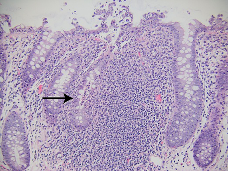 
          Figure 5.
         
          Biopsy specimens of the rectum, sigmoid, and descending, transverse, and proximal ascending colon taken 2 weeks after ipilimumab administration showed active colitis with acute cryptitis, crypt abscesses, and neutrophils within the lamina propria (hematoxylin-eosin, original magnification ×100).
        
