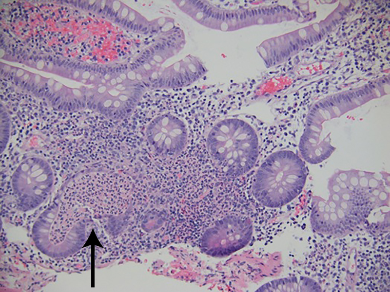 
          Figure 6.
         
          Biopsy specimen of the distal ileum taken 2 weeks after ipilimumab administration showed active ileitis with acute cryptitis, crypt abscesses, and focal architectural distortion (hematoxylin-eosin, original magnification ×100).
        