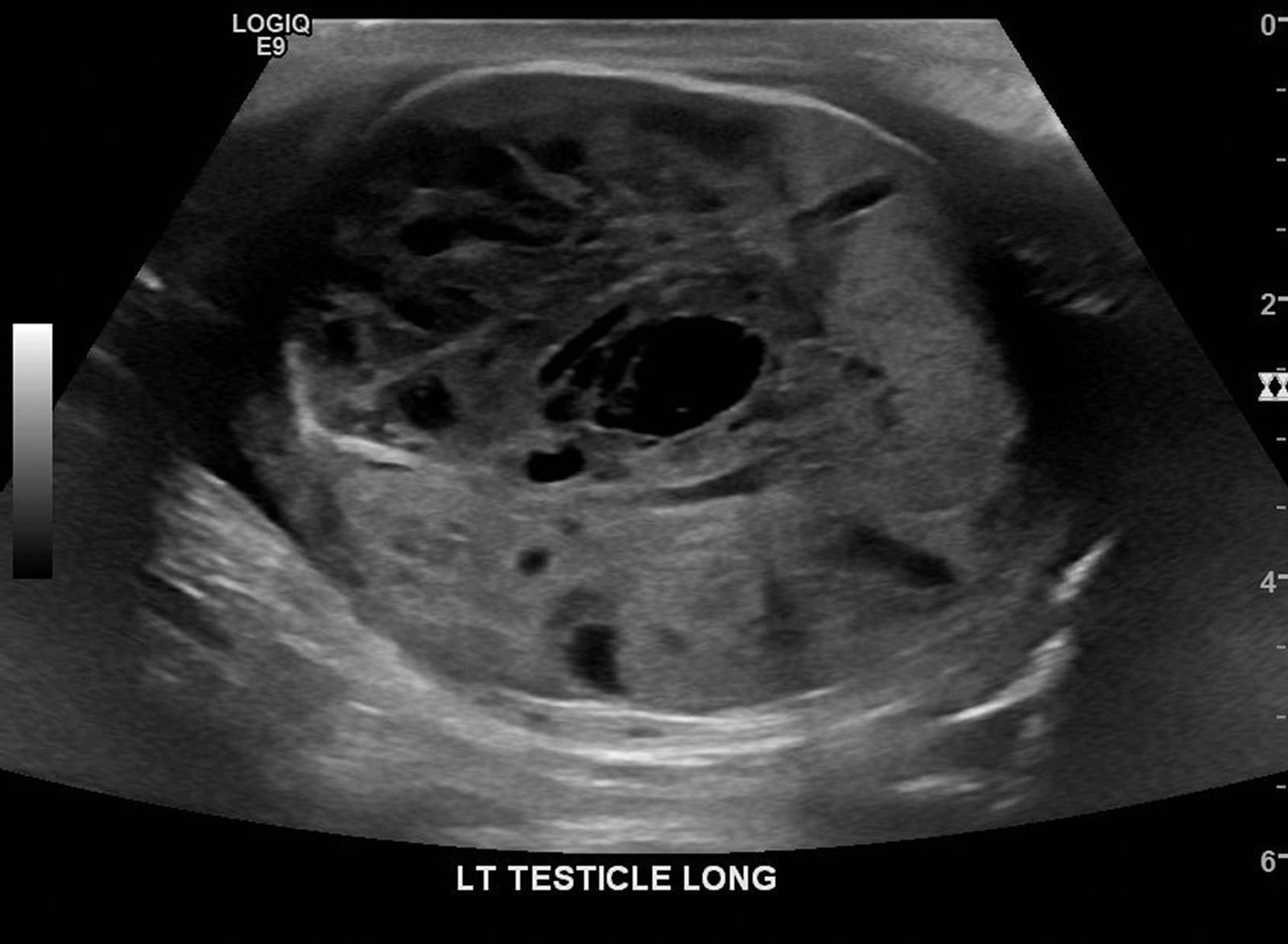 Figure 1. 
          Longitudinal ultrasonographic image of the left testicle showing the majority of the testicle encompassed by a heterogeneous complex hypervascular mass with cystic and solid components consistent with large neoplasm.
        
