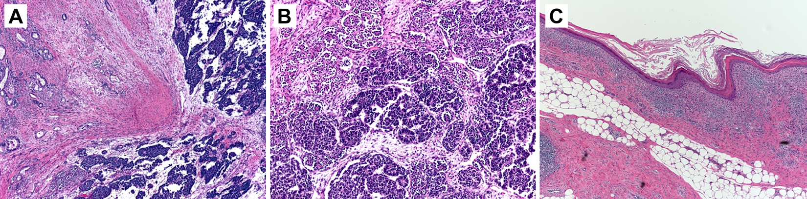 Figure 2. 
          Histologic evaluation using hematoxylin-eosin staining demonstrated (A) teratoma (left side) with secondary somatic malignant neoplasm in the form of nephroblastoma (right side) (low magnification); (B) nephroblastoma with adjacent primitive glomeruloid structures and nephroblastoma composed of columnar epithelial cells with elongated, hyperchromatic nuclei arranged in tubules and nests (high magnification); and (C) teratoma including squamous epithelium and adipose tissue (low magnification).
        