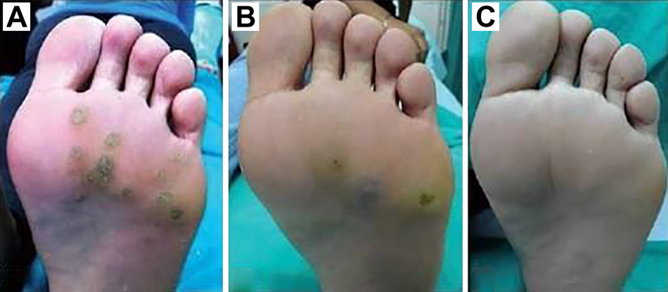Figure 1.
Multiple plantar warts exhibiting full resolution with immunotherapy. (A) Before treatment; (B) after 2 injections of immunotherapy; (C) complete resolution after 4 injections of immunotherapy. Reprinted from Garg S, Baveja S. Intralesional immunotherapy for difficult to treat warts with Mycobacterium w vaccine. J Cutan Aesthet Surg. 2014;7(4):203-208. doi:10.4103/0974-2077.150740