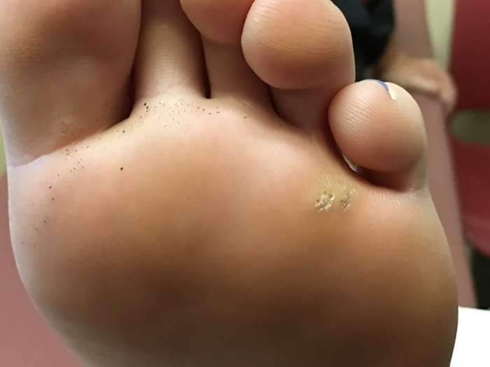 Figure 2.
Plantar wart underlying the left fourth metatarsal head. Note the presence of visible thrombosed capillaries and disruption of dermatoglyphics.