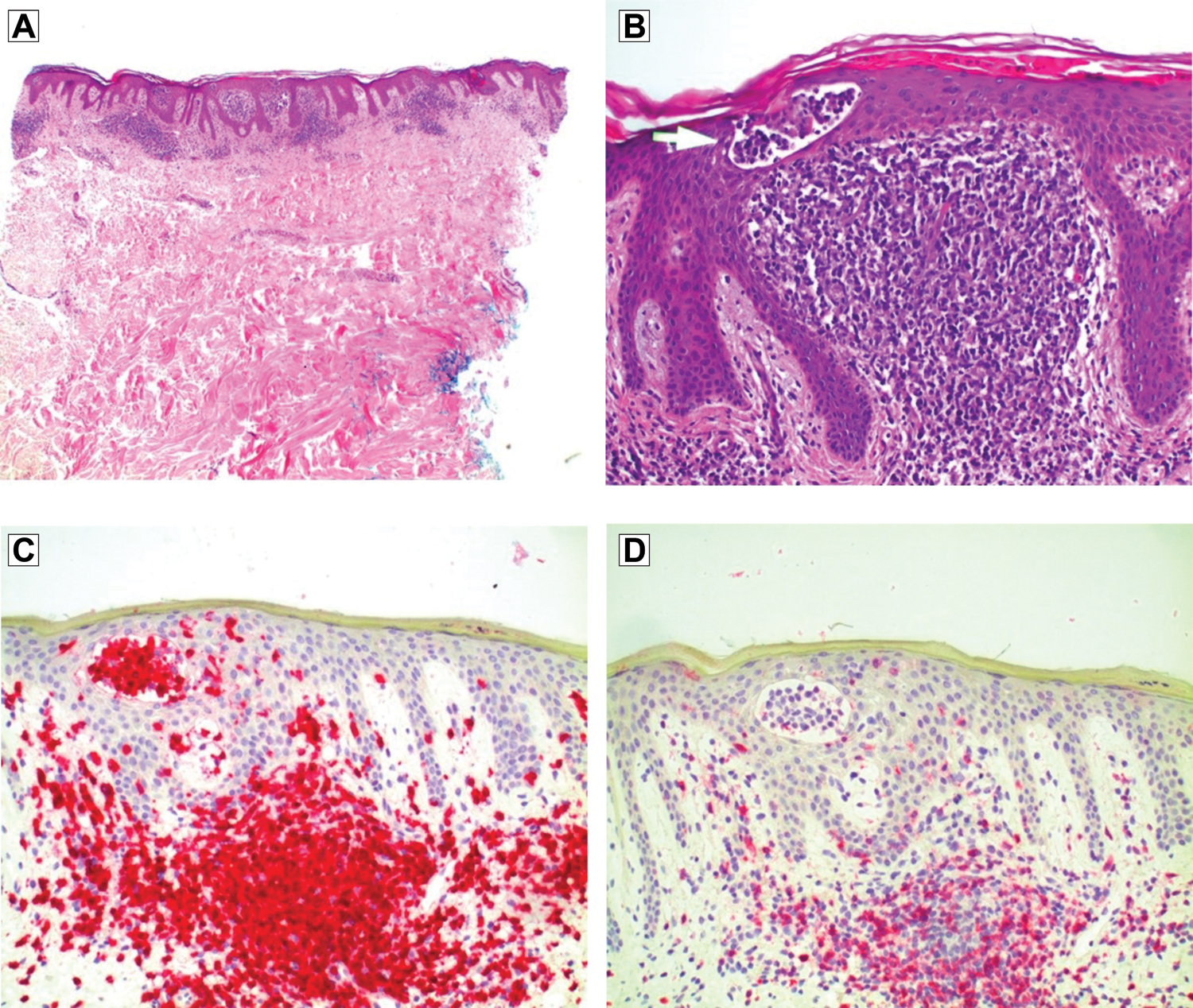 
          Figure 2.
         
          Biopsy specimen of the right side of the waist in a patient with a persistent rash revealed (A) lymphocytic infiltrate with epidermotrophism and a lack of significant spongiosis (hematoxylin-eosin, original magnification ×40), (B) atypical lymphoid infiltrate with Pautrier microabscess formation (hematoxylin-eosin, original magnification ×200), (C) lymphocytes staining diffusely with CD3 (hematoxylin-eosin, original magnification ×200), and (D) loss of CD7 staining (immunohistochemical, original magnification ×200).
        