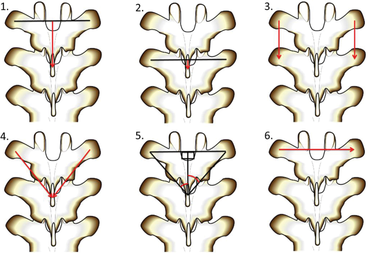 Figure 2. 
          Drawings of each measurement (measurements 1 through 6), as described in the text, used to measure the anatomic locations and relationships of the thoracic transverse and spinous processes. Red lines represent the measured distances. Black lines show how the red lines relate to the spinous and transverse processes.
        