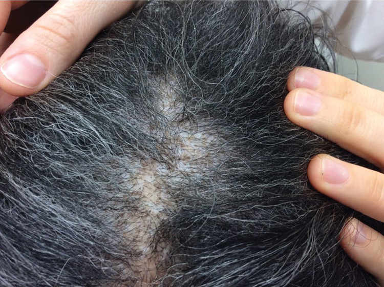 Figure 1.
Patches with mottled hypopigmentation, loss of follicular ostia, and thinning of the hair in a patient with scalp sarcoidosis.