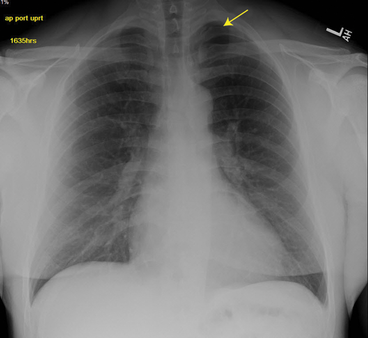 Figure 1.
Anterior-posterior upright chest radiograph demonstrating a small left apical pneumothorax in a 44-year-old man who had dry needling of the infraspinatus, supraspinatus, rhomboid, and paraspinal muscles.