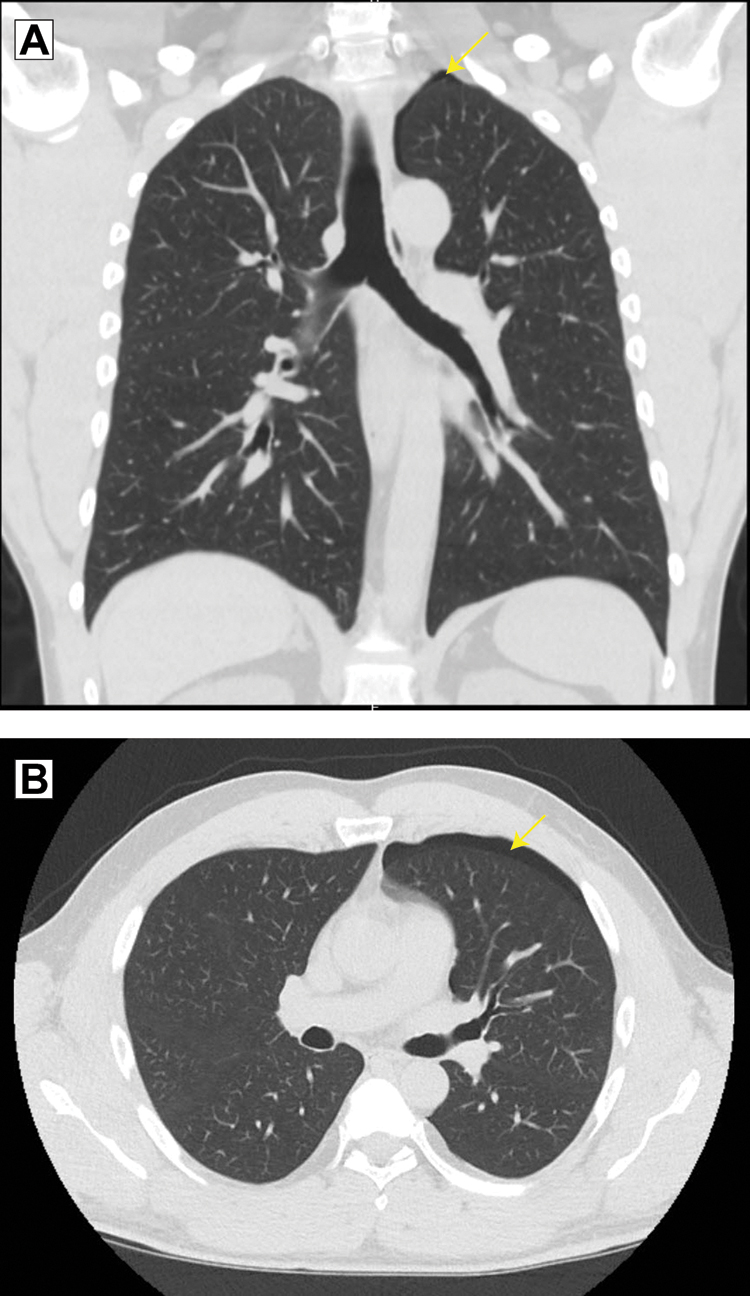 Figure 2.
Computed tomographic images of the chest in the (A) coronal view and (B) axial view demonstrated a small, left-sided apical pneumothorax. The patient was a 44-year-old man who had undergone dry needling of the infraspinatus, supraspinatus, rhomboid, and paraspinal muscles 1 day earlier.
