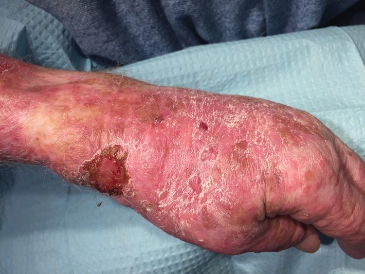 Figure 1. Elderly patient with topical imiquimod–induced erythema multiforme. Left hand with edema, superficial ulceration, and scattered small erythematous targetoid lesions in the area of previously-applied imiquimod.