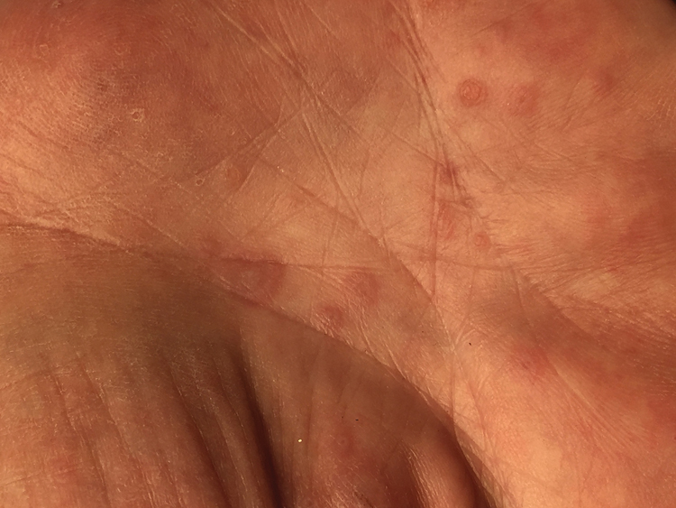 Figure 2. Multiple erythematous, targetoid lesions on the palmar surface of the hand.