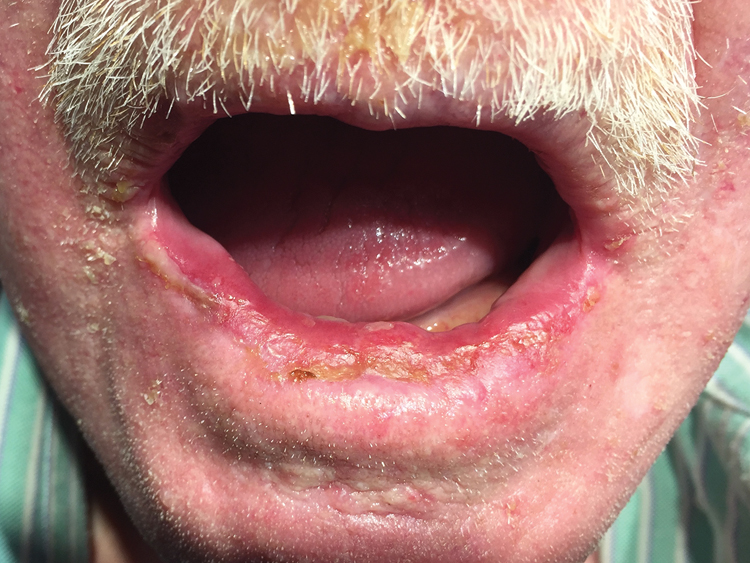 Figure 3. Scattered erosions, ulcers, and crusts involving the mucosal surface and vermillion border of the lower lip.